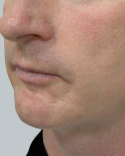 cs1_liposuction_Face_after-img