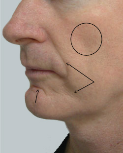 cs1_liposuction_face_before-img