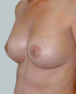 cs1_liposuction_Face_after-img