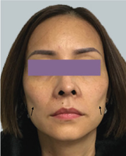 cs1_liposuction_face_before-img