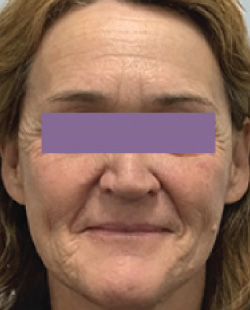 cs1_liposuction_Face_after-img