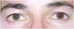 cs1_liposuction_face_before-img