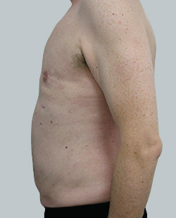 cs1_liposuction_Face_after-img