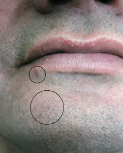 cs1_liposuction_Face_after-img