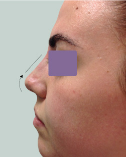 cs1_liposuction_Face_after-img