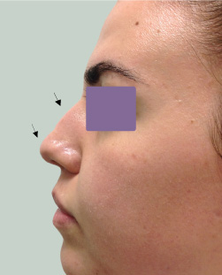 cs1_liposuction_face_before-img