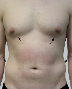 cs1_liposuction_face_before-img