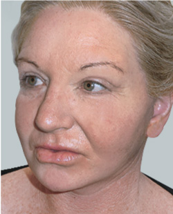 cs1_liposuction_Face_after-img