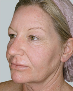 cs1_liposuction_face_before-img