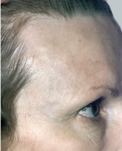 cs1_liposuction_Face_after-img