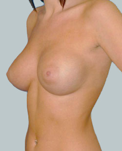 cs1_liposuction_Face_after-img