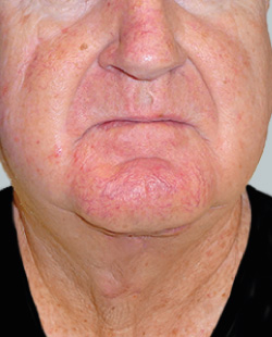 cs1_liposuction_Face_after-img