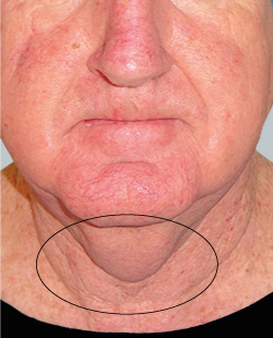 cs1_liposuction_face_before-img