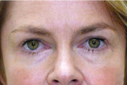 cs1_liposuction_Face_after-img