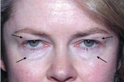 cs1_liposuction_face_before-img