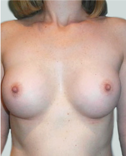 cs1_liposuction_Face_after-img