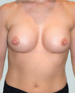 cs1_liposuction_Face_after-img