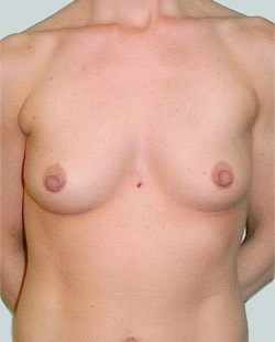 cs1_liposuction_face_before-img