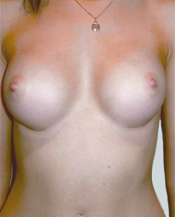 cs1_liposuction_Face_after-img