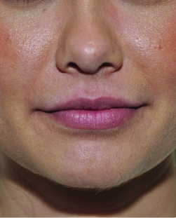 cs1_liposuction_face_before-img