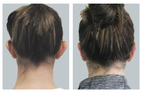 Otoplasty at the Me Clinic