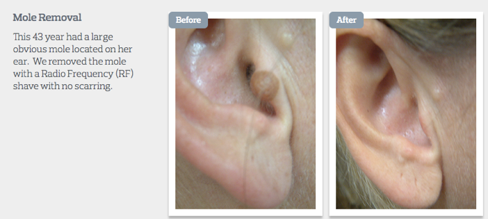 Mole removal guide at the Me Clinic