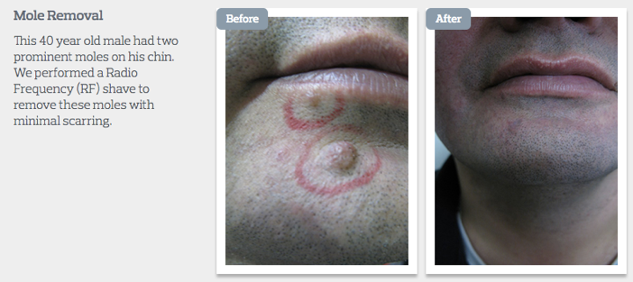 Mole removal guide at the Me Clinic