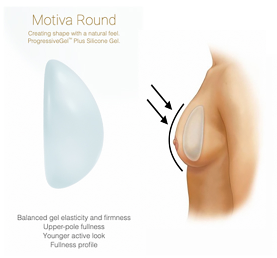 Motiva Implant — For a ROUND look