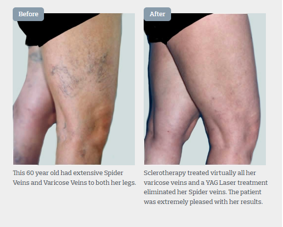 Leg Vein Treatment - Eliminate Spider & Varicose Veins - SKN