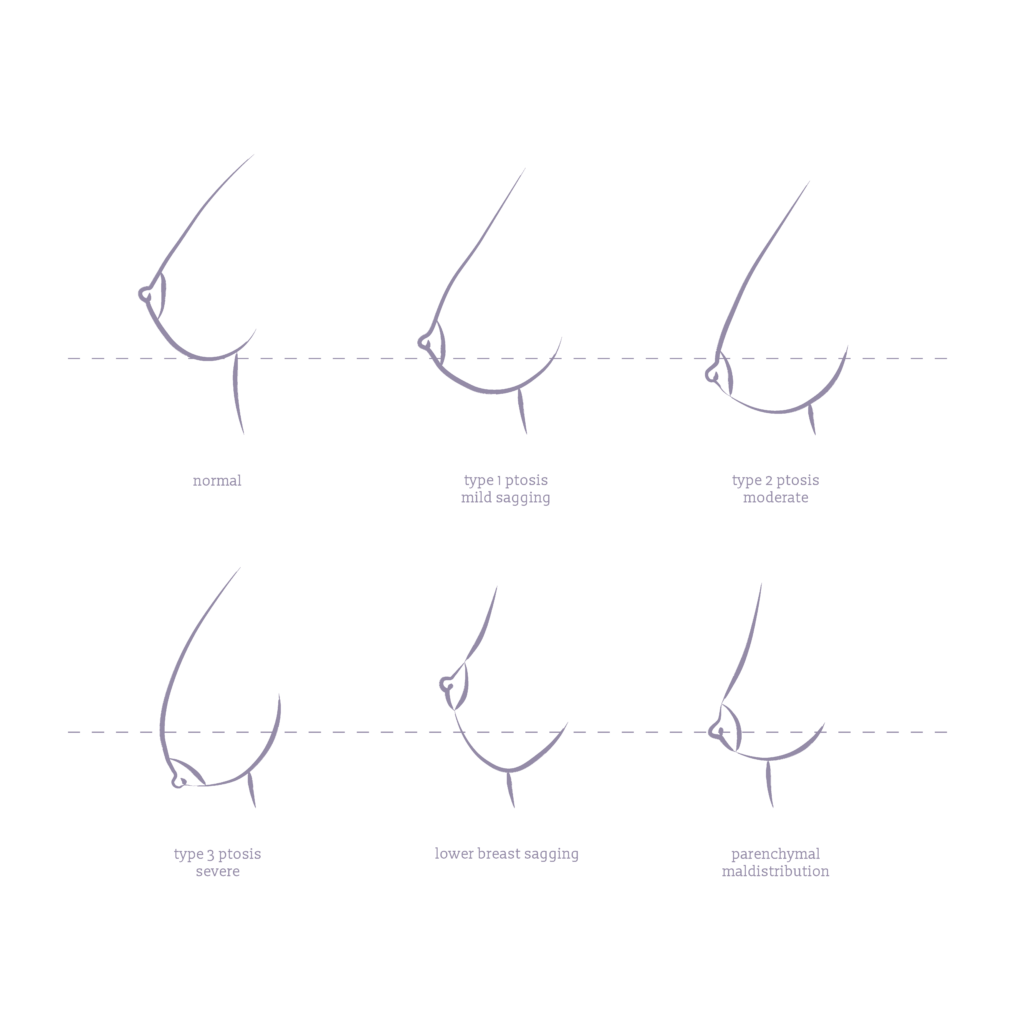 An infographic that shows the different degrees of ptosis (sag) of breasts that require breast lifts.