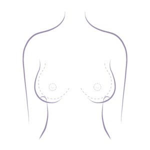 An image design that demonstrates the enhancement breast surgery can achieve in fixing uneven breasts. 