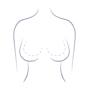 An image illustrating a breast reduction and lift potential to reduce and shape the breasts.