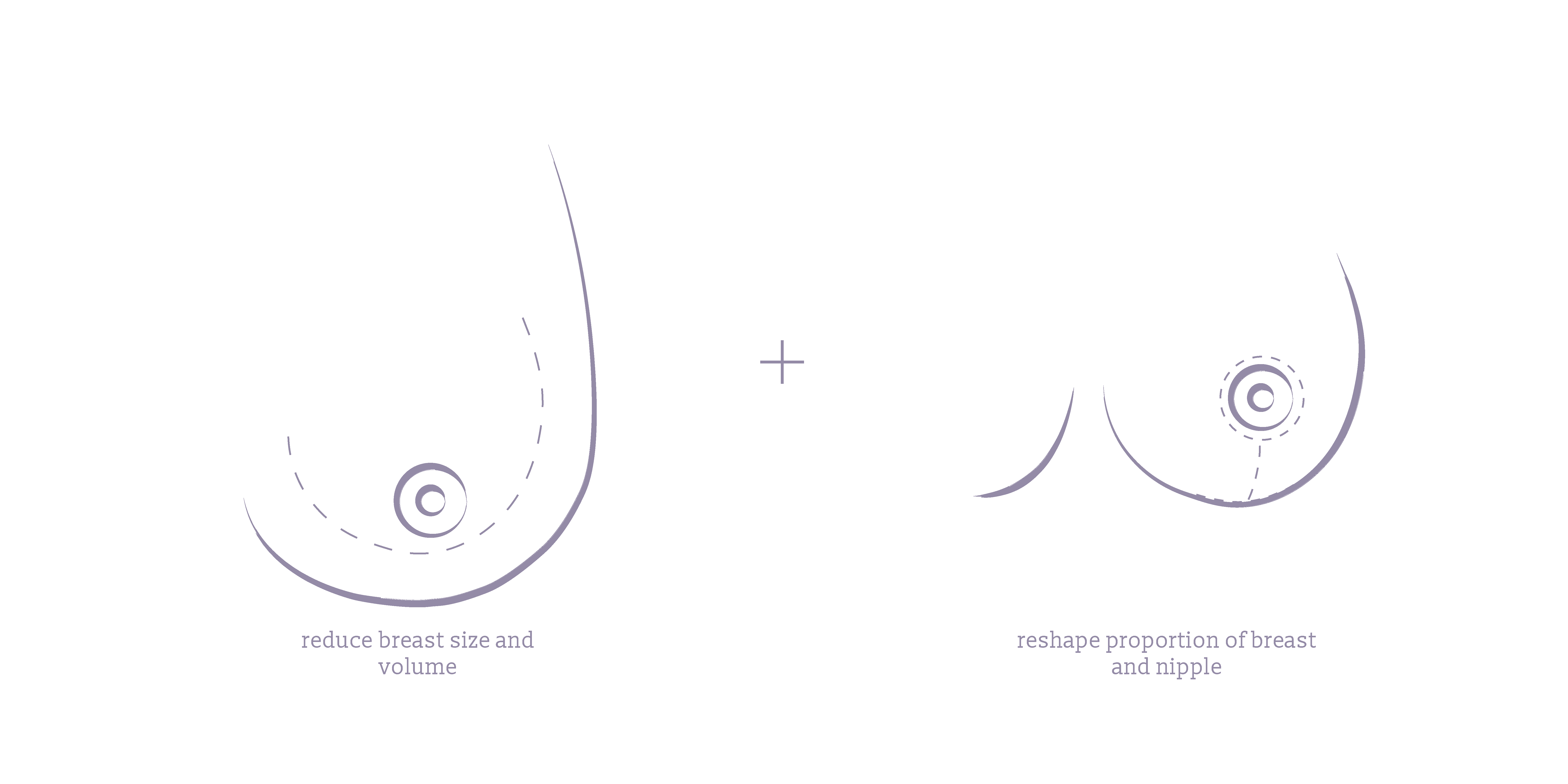 Breast Reduction and Lift Surgery - Melbourne