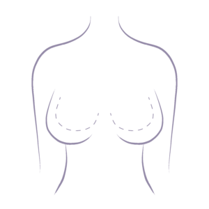 An image design of the restoration ability of a Breast Reduction surgery in Melbourne at Me Clinic. A breast reduction can reduce breast size and alleviate discomfort.
