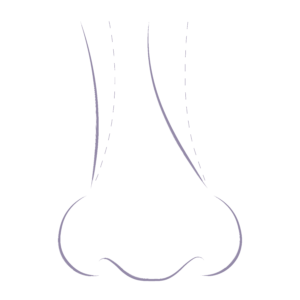 Illustration demonstrating the common nose concerns relating to a crooked nose.