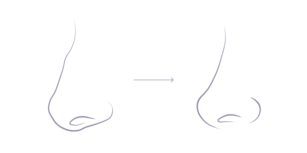 Illustration of before and after of a nose, where rhinoplasty can correct bumps and tip issues for a beautiful nose.