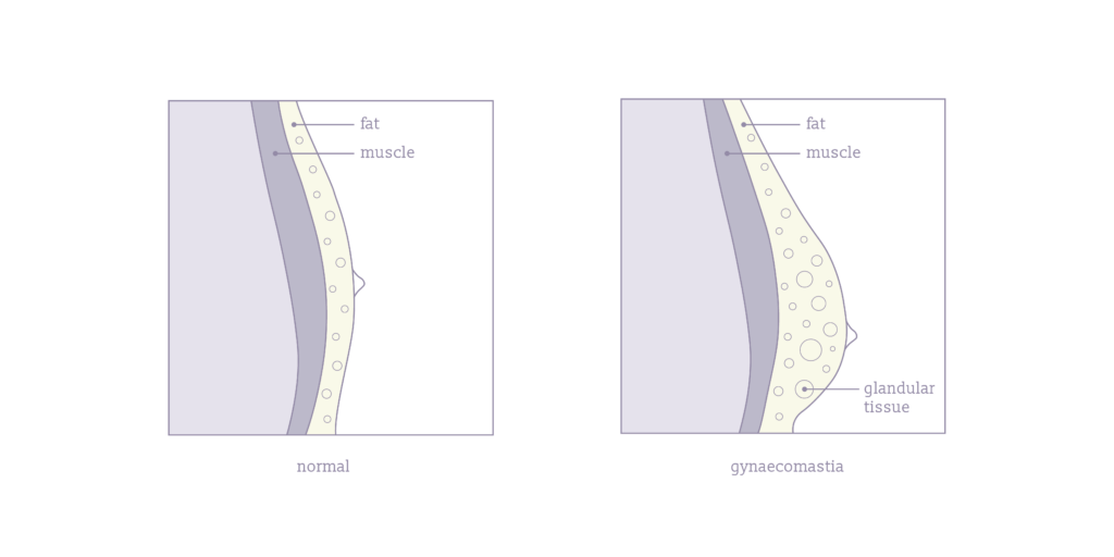 An infographic of the glandular tissue build up for gynaecomastia.
