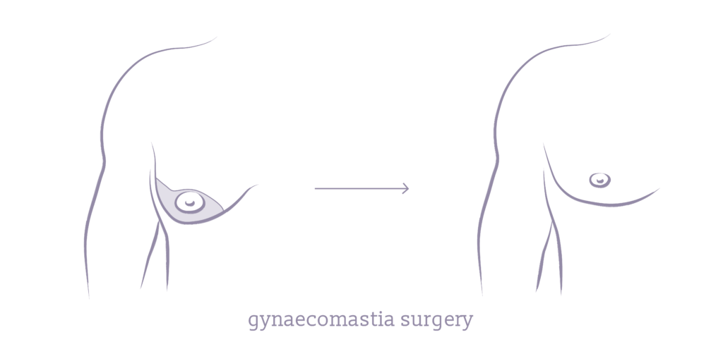 Illustration of how gynaecomastia surgery can achieve a more aesthetic chest contour.