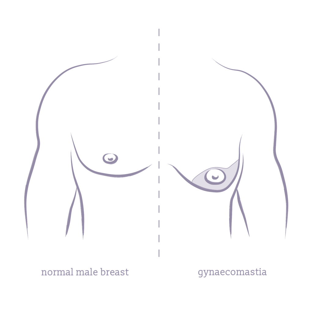 A side by side illustration of a regular male breast and gynaecomastia.