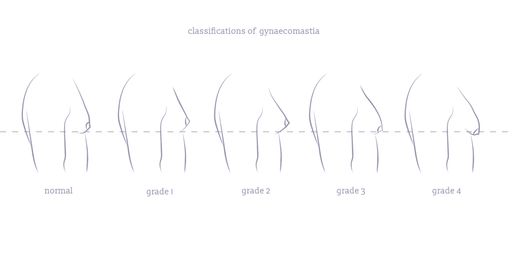 An infographic of the different severities of gynaecomastia from grade 1 to grade 2.