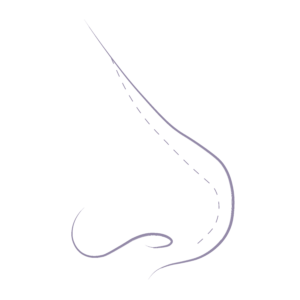 Illustration demonstrating the common nose concerns relating to a rounded tip commonly referred to as a bulbous tip.