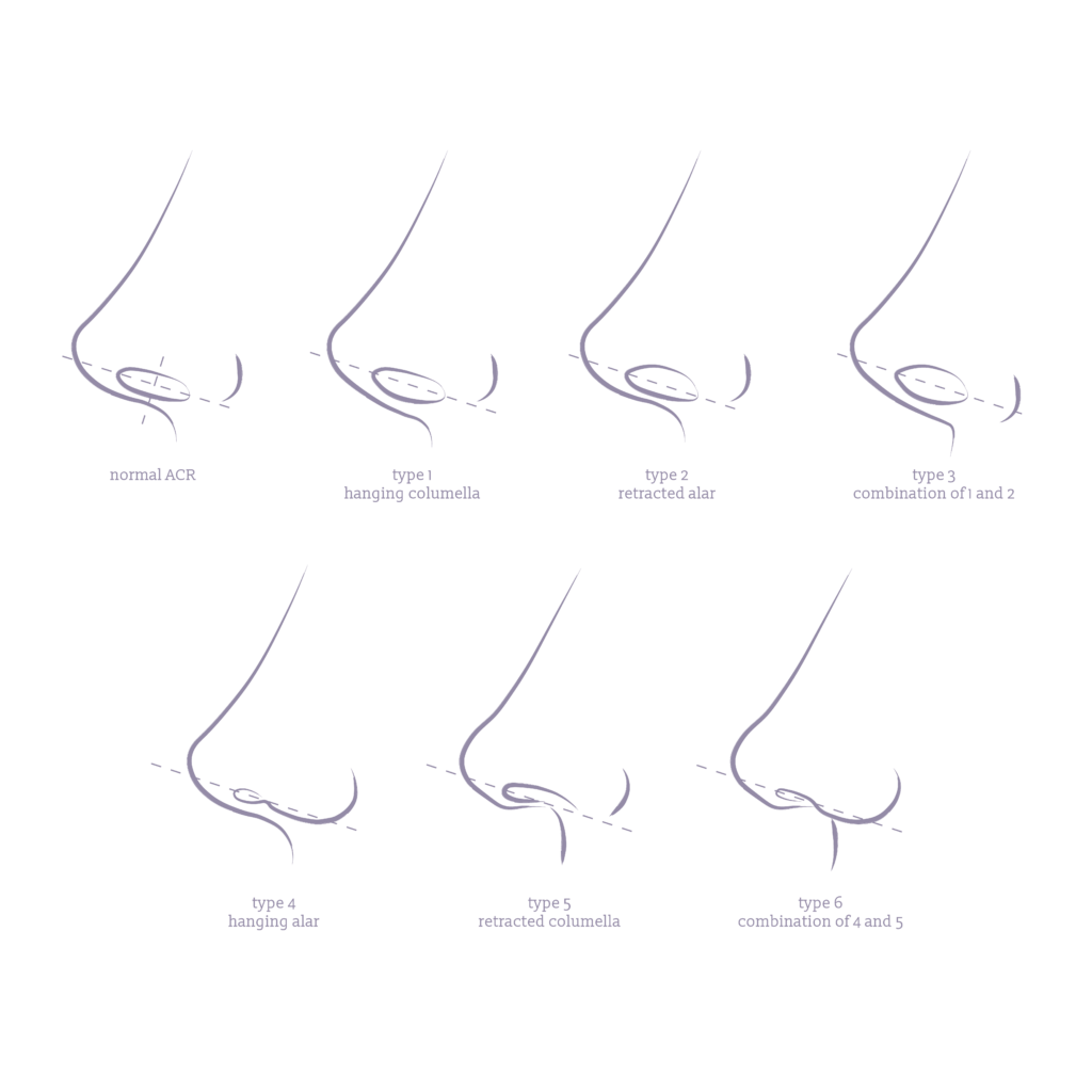 An infographic of differing columella and alars that patiens have that can be adjusted by rhinoplasty.