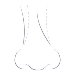 Illustration demonstrating the common nose concerns relating to a crooked nose.