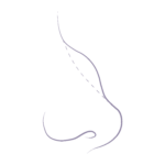 Illustration demonstrating the common nose concerns relating to nasal bumps commonly referred to as dorsal hump.