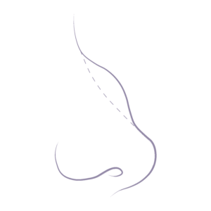 Illustration demonstrating the common nose concerns relating to nasal bumps commonly referred to as dorsal hump.