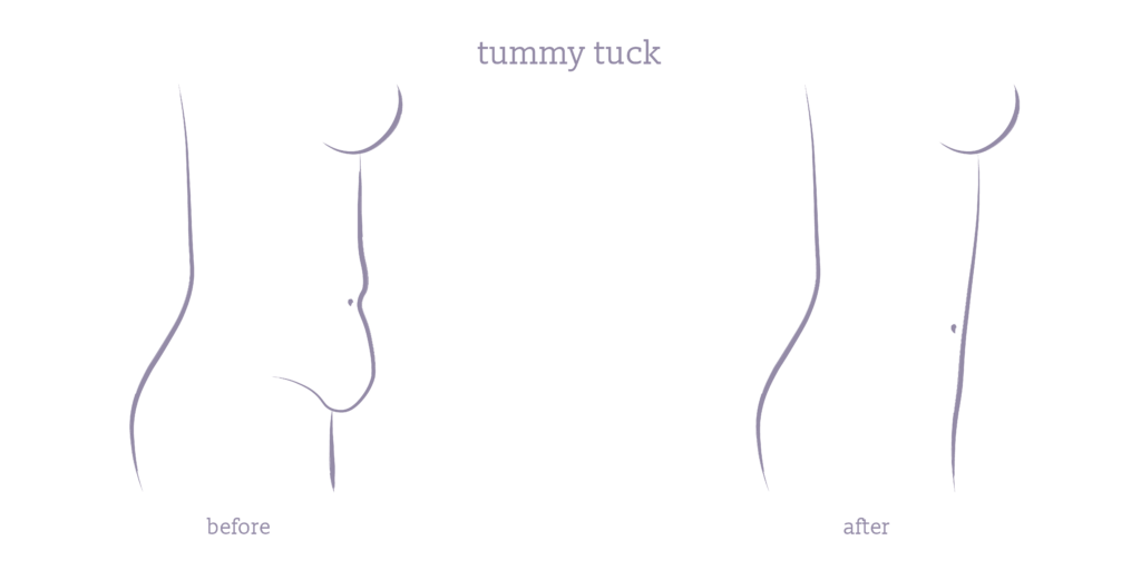 An illustration of a before and after image of a tummy tuck or abdominoplasty.