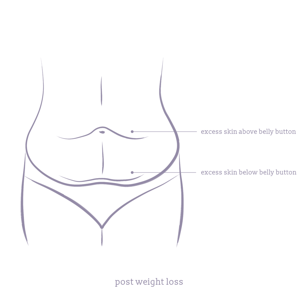 A diagram showing post-weight loss tummy tuck patients usually have loose skin below and above the belly button.