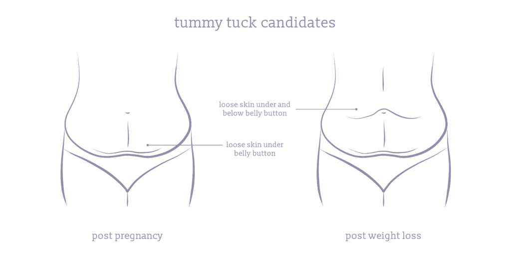 A diagram comparing where loose skin is found for post-pregnancy and post-weight loss tummy tuck candidates.