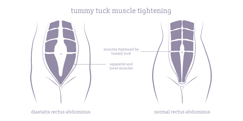 A diagram highlighting diastasis rectus abdominus, and how a tummy tuck tightens the abdominal muscles.