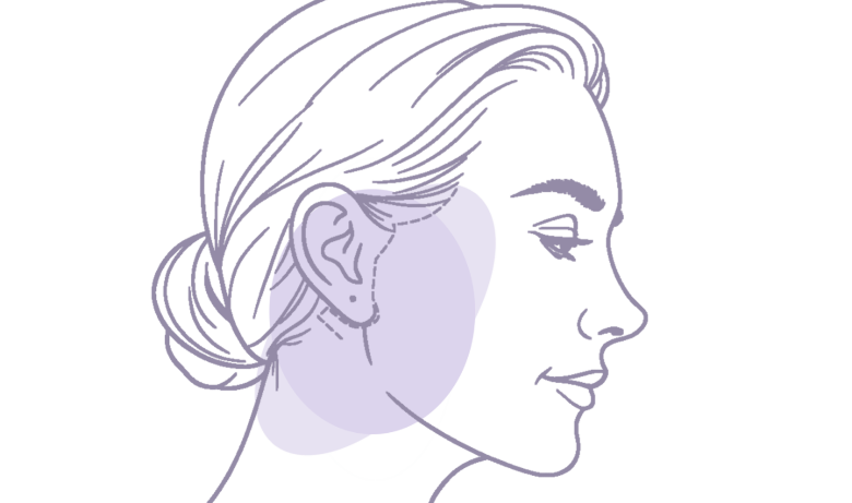 Managing Facelift Scars A Comprehensive Guide Featured Image
